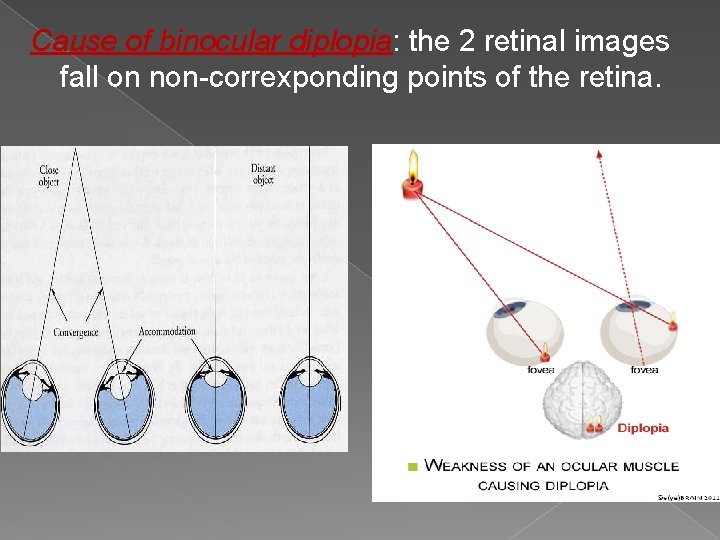 Cause of binocular diplopia: the 2 retinal images fall on non-correxponding points of the