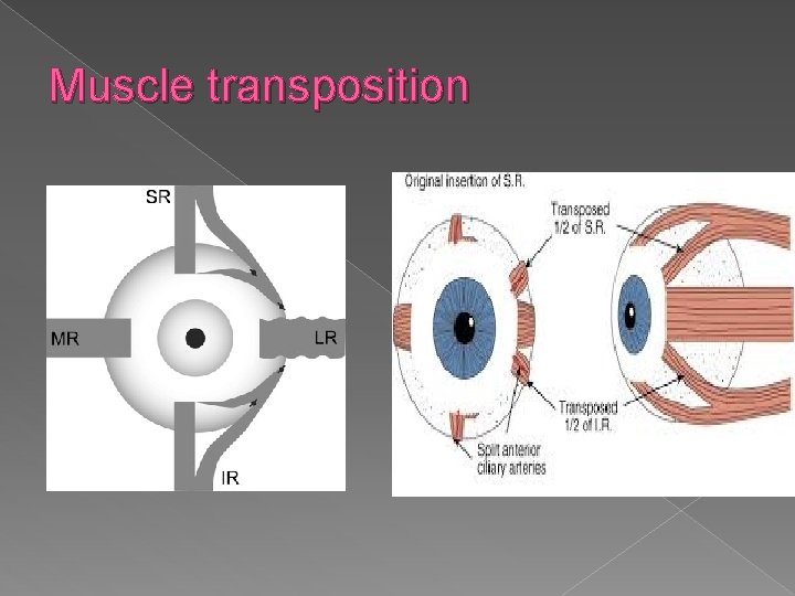 Muscle transposition 