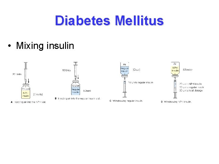 Diabetes Mellitus • Mixing insulin 