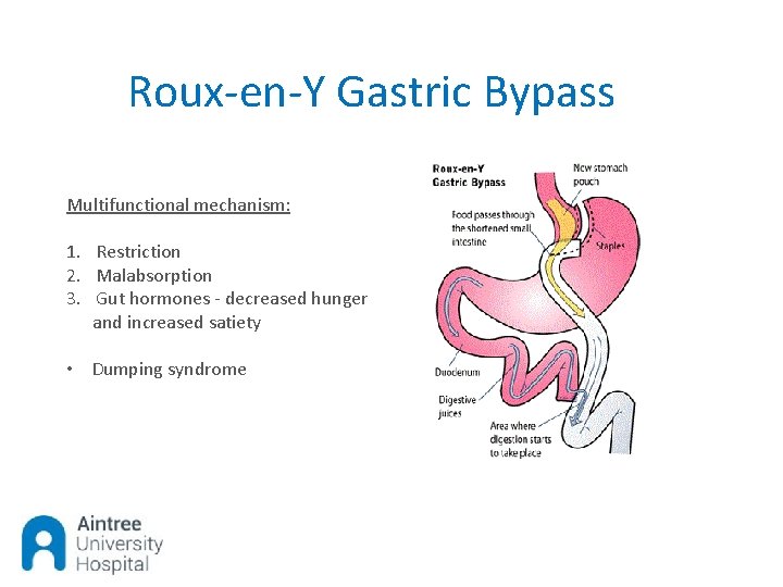 Roux-en-Y Gastric Bypass Multifunctional mechanism: 1. Restriction 2. Malabsorption 3. Gut hormones - decreased