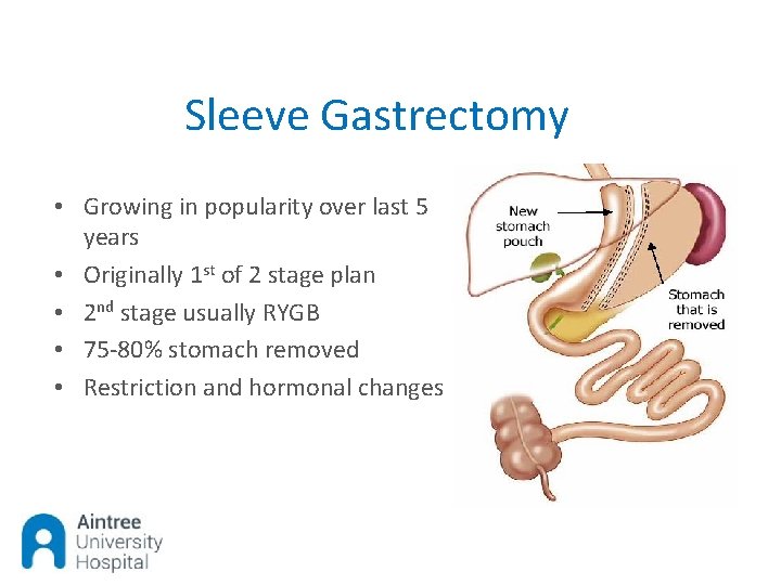 Sleeve Gastrectomy • Growing in popularity over last 5 years • Originally 1 st