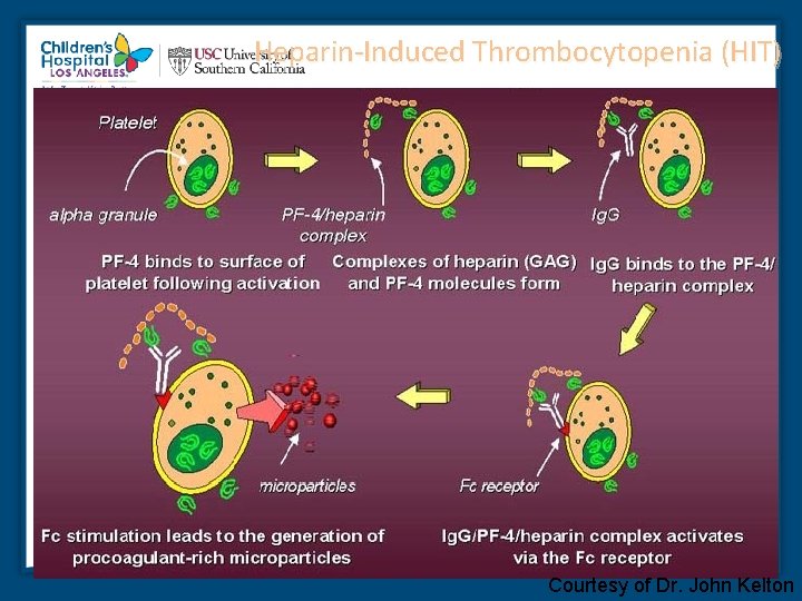 Heparin-Induced Thrombocytopenia (HIT) Courtesy of Dr. John Kelton 