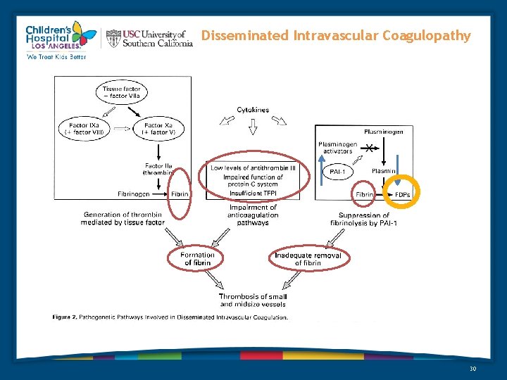 Disseminated Intravascular Coagulopathy 30 Disseminated Intravascular Coagulopathy 30