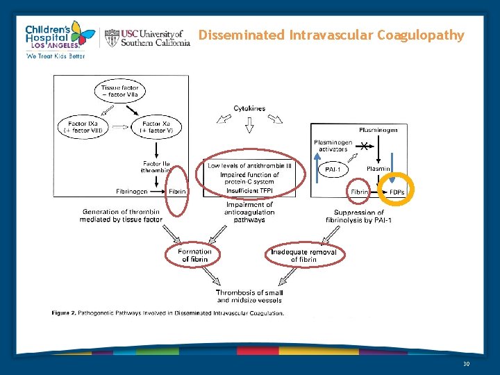 Disseminated Intravascular Coagulopathy 30 