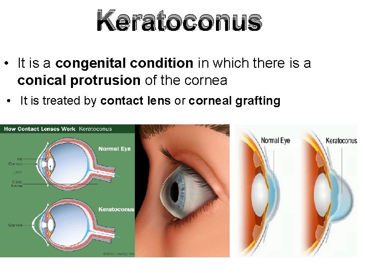 Keratoconus • It is a congenital condition in which there is a conical protrusion