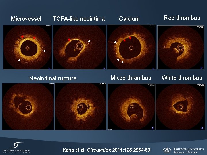 Microvessel TCFA-like neointima Neointimal rupture Calcium Red thrombus Mixed thrombus White thrombus Kang et