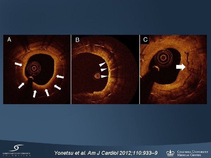 Yonetsu et al. Am J Cardiol 2012; 110: 933– 9 