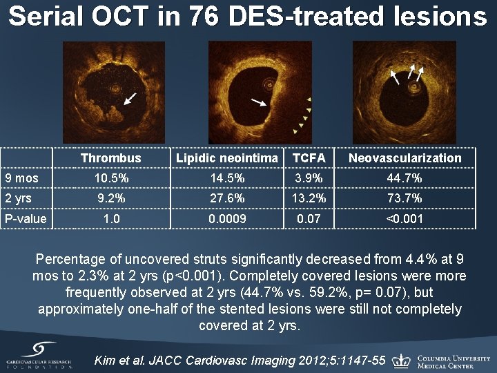 Serial OCT in 76 DES-treated lesions Thrombus Lipidic neointima TCFA Neovascularization 9 mos 10.