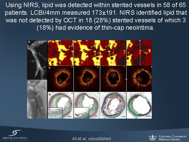 Using NIRS, lipid was detected within stented vessels in 58 of 65 patients. LCBI/4