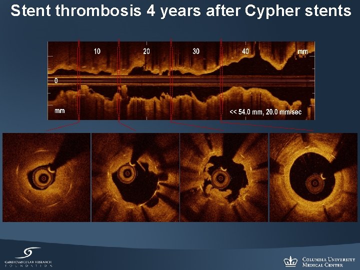 Stent thrombosis 4 years after Cypher stents 