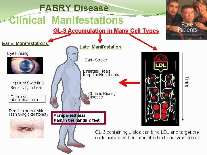 FABRY Disease Clinical Manifestations GL-3 Accumulation in Many Cell Types Early Manifestations Late Manifestation