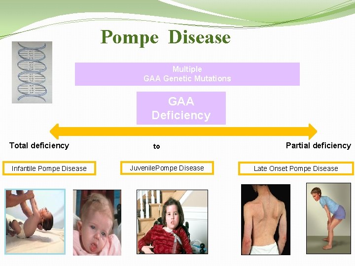 Pompe Disease Multiple GAA Genetic Mutations GAA Deficiency Total deficiency Infantile Pompe Disease to