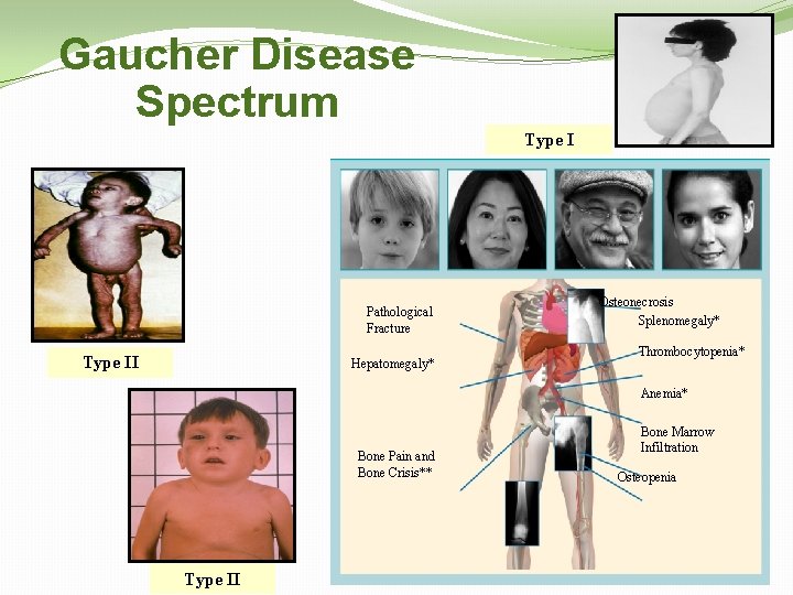 Gaucher Disease Spectrum Type I Pathological Fracture Type II Hepatomegaly* Osteonecrosis Splenomegaly* Thrombocytopenia* Anemia*