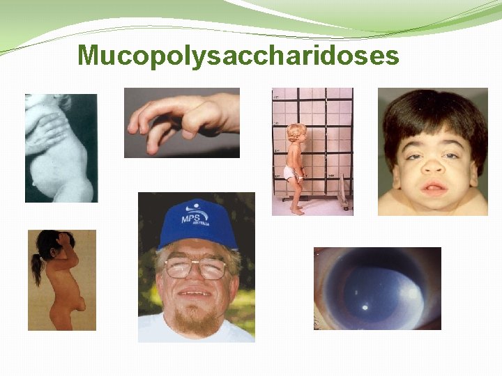 Mucopolysaccharidoses 