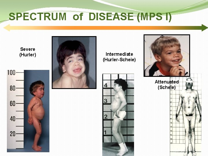 SPECTRUM of DISEASE (MPS I) Severe (Hurler) Intermediate (Hurler-Scheie) Attenuated (Scheie) 28 