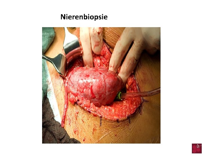 Nierenbiopsie 