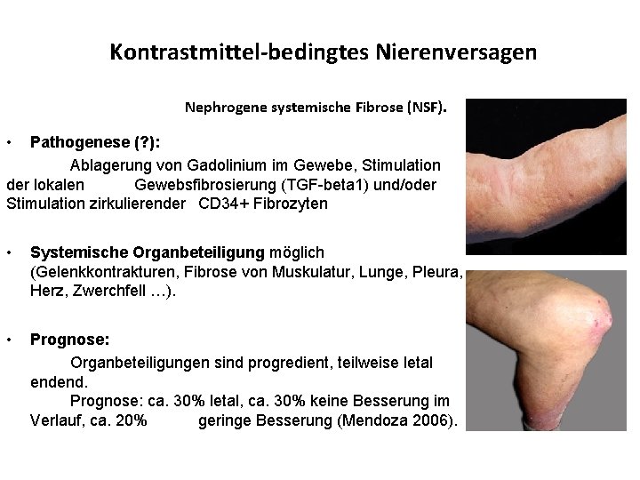 Kontrastmittel-bedingtes Nierenversagen Nephrogene systemische Fibrose (NSF). • Pathogenese (? ): Ablagerung von Gadolinium im