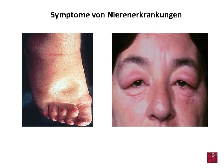 Symptome von Nierenerkrankungen 