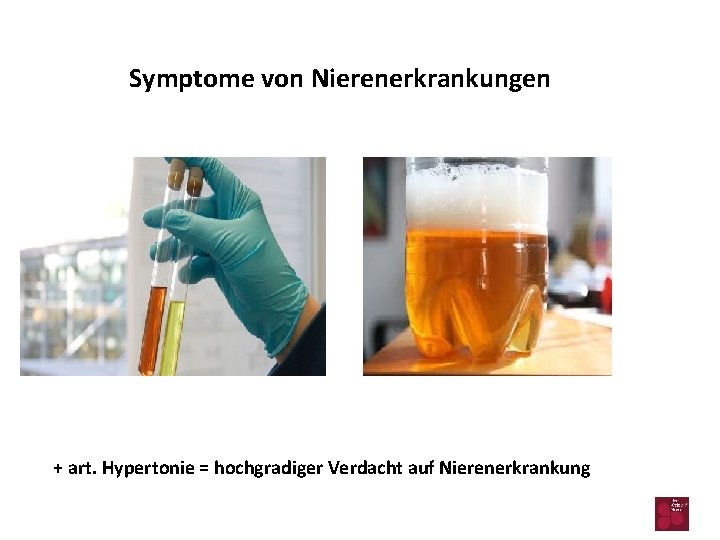 Symptome von Nierenerkrankungen + art. Hypertonie = hochgradiger Verdacht auf Nierenerkrankung 