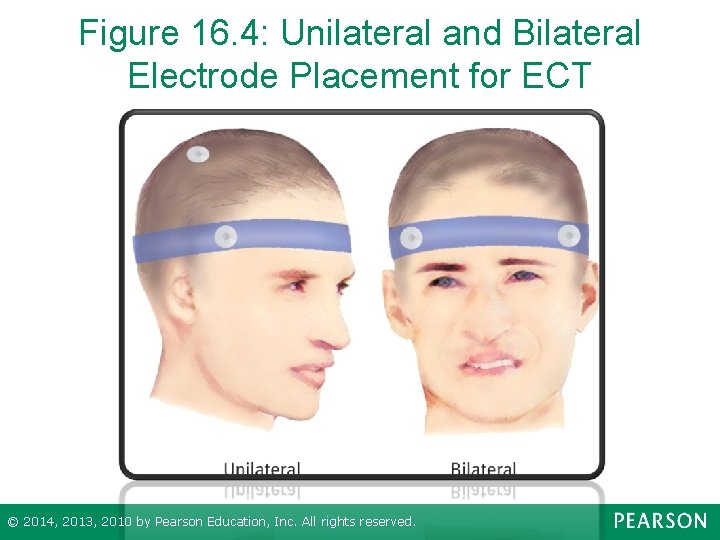 Figure 16. 4: Unilateral and Bilateral Electrode Placement for ECT © 2014, 2013, 2010