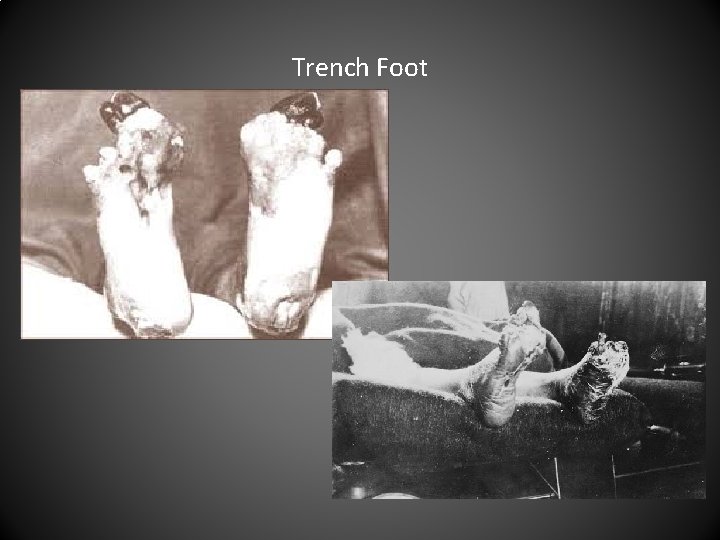 Trench Foot 