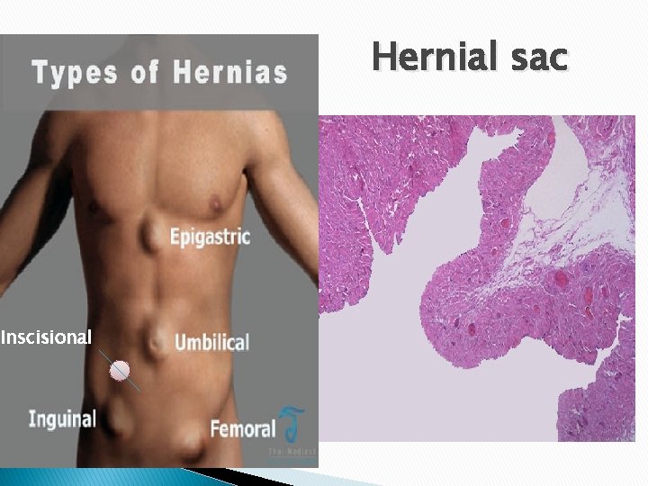 Hernial sac Inscisional 