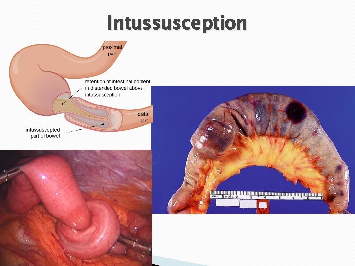 Intussusception 