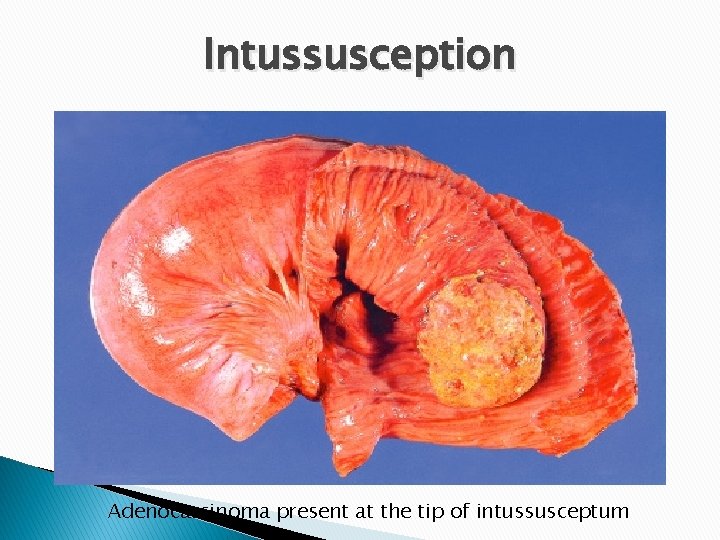 Intussusception Adenocarcinoma present at the tip of intussusceptum 