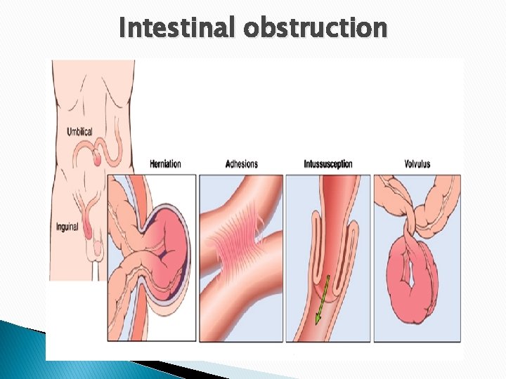 Intestinal obstruction 