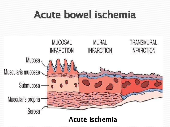 Acute bowel ischemia Acute ischemia 