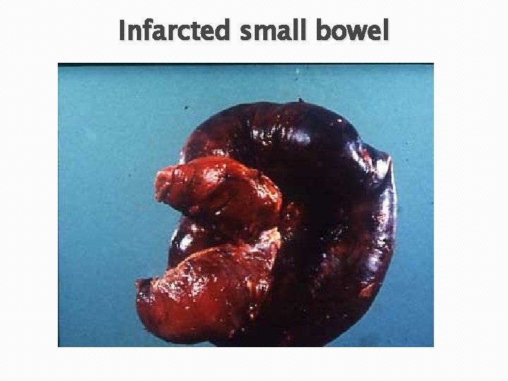 Infarcted small bowel 