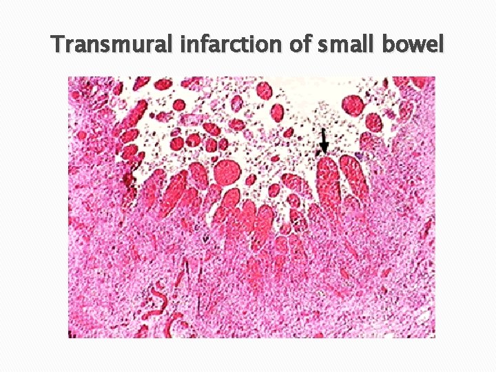 Transmural infarction of small bowel 