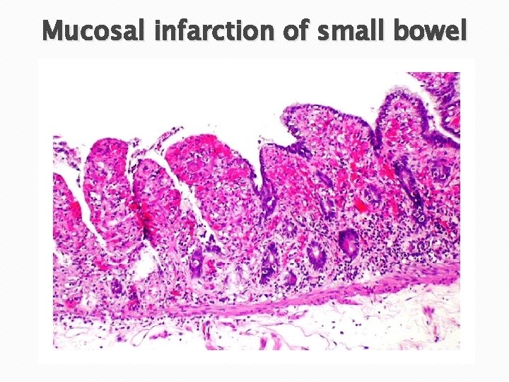 Mucosal infarction of small bowel 