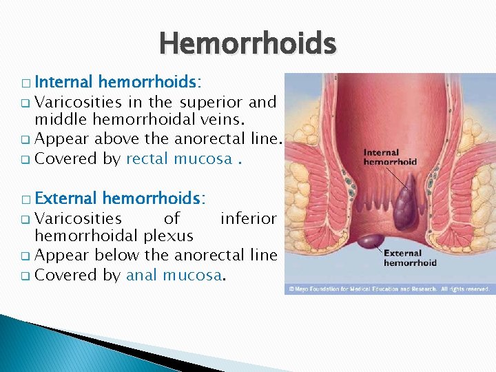 Hemorrhoids � Internal hemorrhoids: q Varicosities in the superior and middle hemorrhoidal veins. q