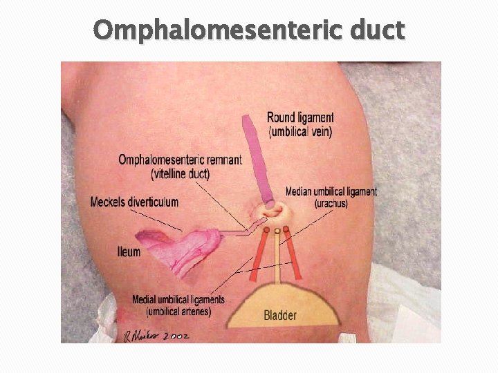 Omphalomesenteric duct 