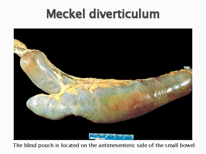 Meckel diverticulum The blind pouch is located on the antimesenteric side of the small