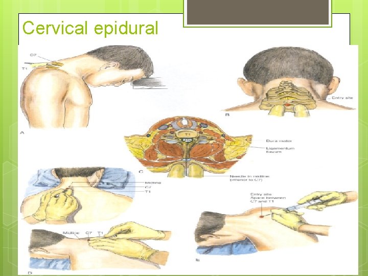 Cervical epidural 