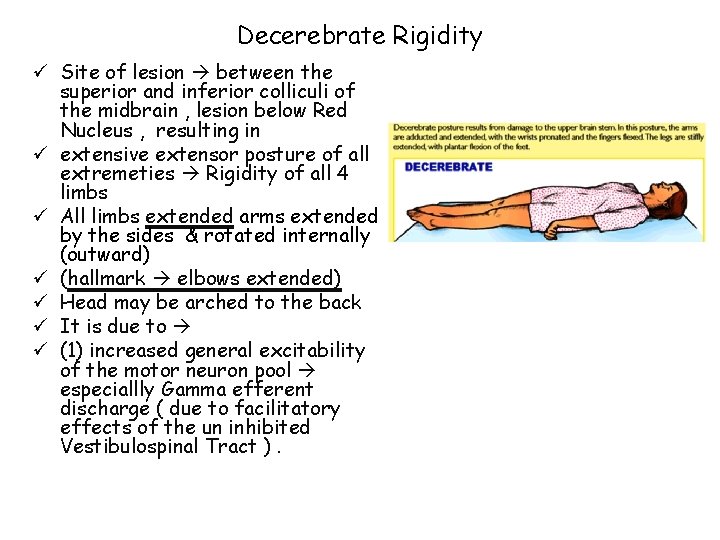 Decerebrate Rigidity ü Site of lesion between the superior and inferior colliculi of the