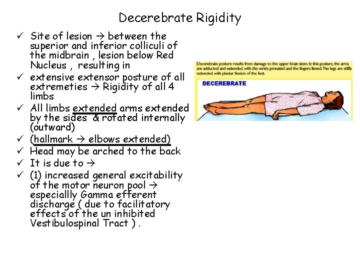 Decerebrate Rigidity ü Site of lesion between the superior and inferior colliculi of the Decerebrate Rigidity ü Site of lesion between the superior and inferior colliculi of the