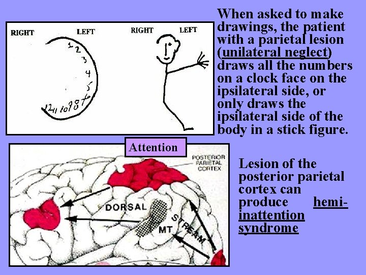 When asked to make drawings, the patient with a parietal lesion (unilateral neglect) draws
