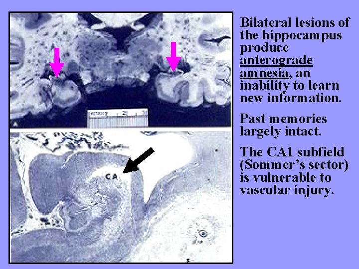 Bilateral lesions of the hippocampus produce anterograde amnesia, an inability to learn new information.