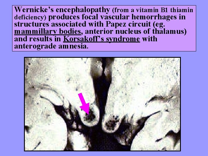 Wernicke’s encephalopathy (from a vitamin B 1 thiamin deficiency) produces focal vascular hemorrhages in