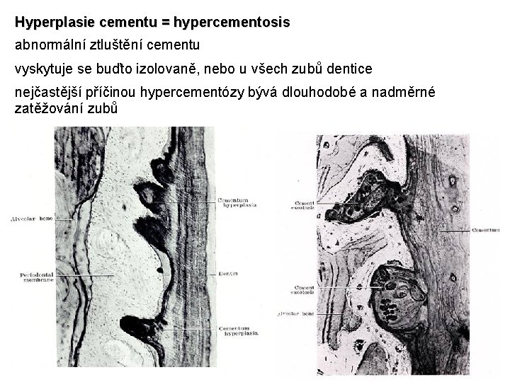 Hyperplasie cementu = hypercementosis abnormální ztluštění cementu vyskytuje se buďto izolovaně, nebo u všech