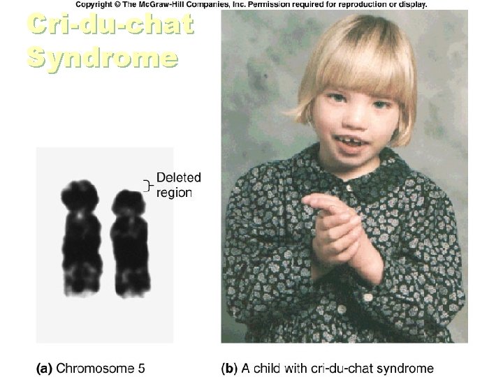 Cri-du-chat Syndrome 