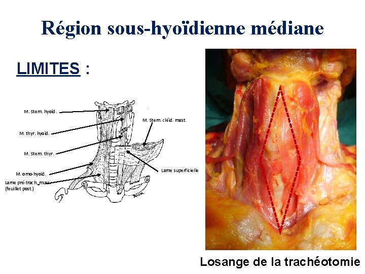 Région sous-hyoïdienne médiane LIMITES : M. Stern. hyoïd. M. Stern. cléid. mast. M. thyr.