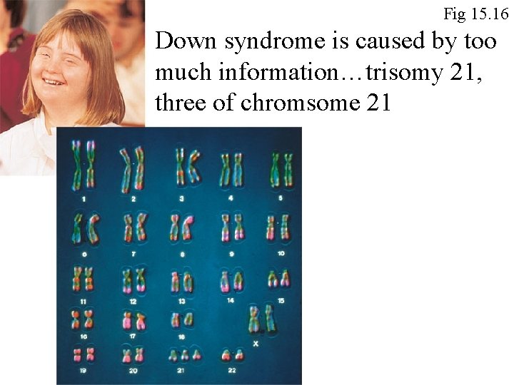 Fig 15. 16 Down syndrome is caused by too much information…trisomy 21, three of