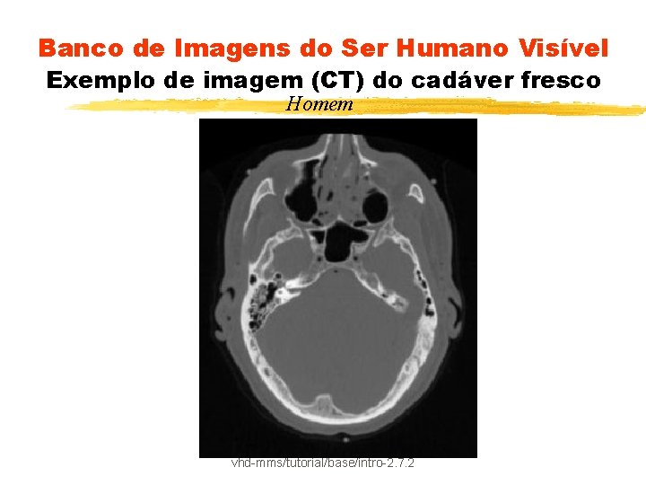 Banco de Imagens do Ser Humano Visível Exemplo de imagem (CT) do cadáver fresco