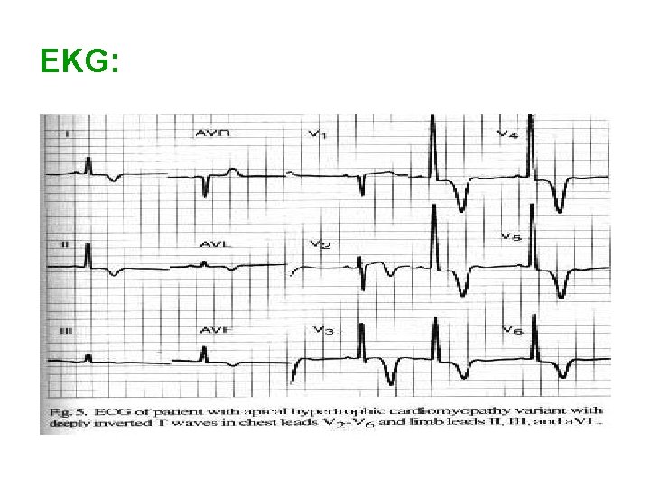 EKG: 