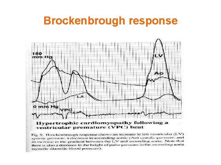 Brockenbrough response 