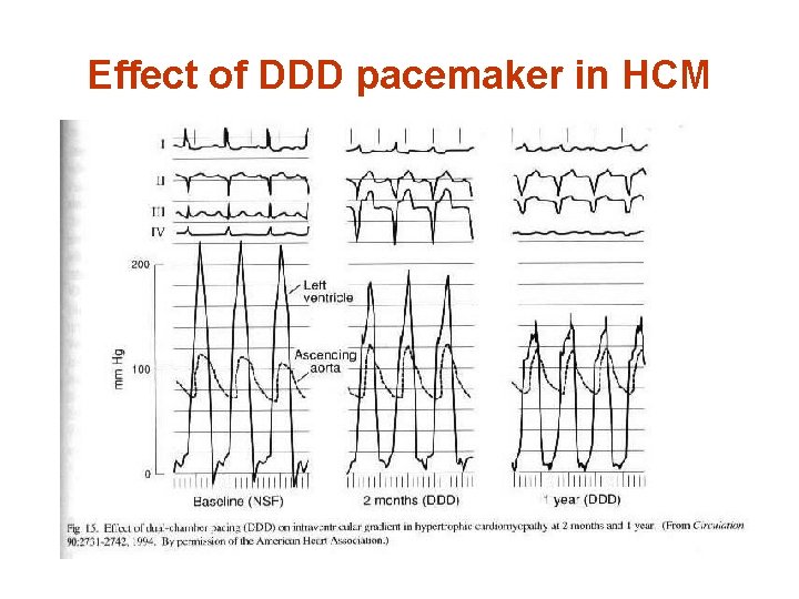 Effect of DDD pacemaker in HCM 